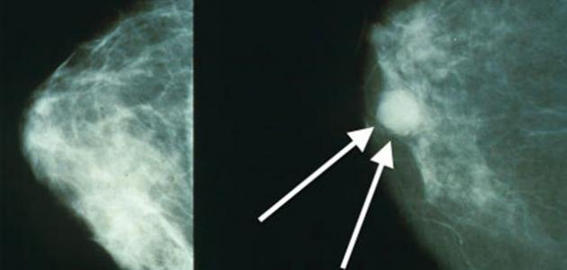 كيف يتم اكتشاف سرطان الثدي