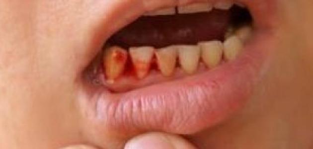 ما هي أسباب خروج الدم من الفم