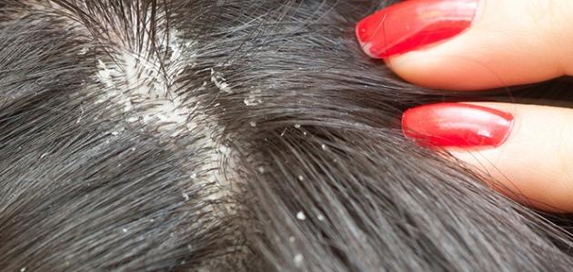 طرق علاج القمل في الشعر
