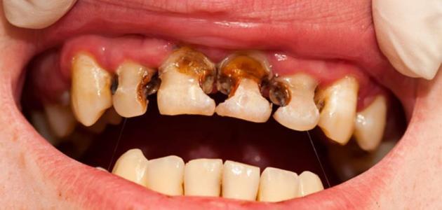 كيف تتخلص من تسوس الاسنان