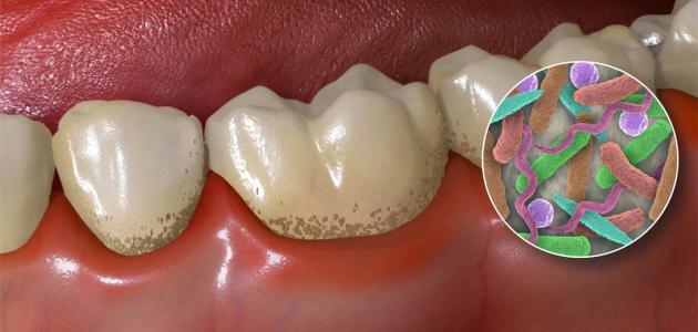 وصفة لعلاج تسوس الأسنان