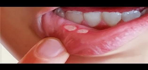 فطريات الفم عند الأطفال وعلاجها