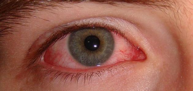 كيفية علاج احمرار العين