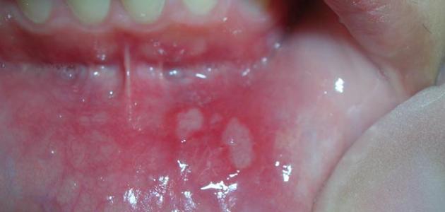 أسباب الفطريات في الفم