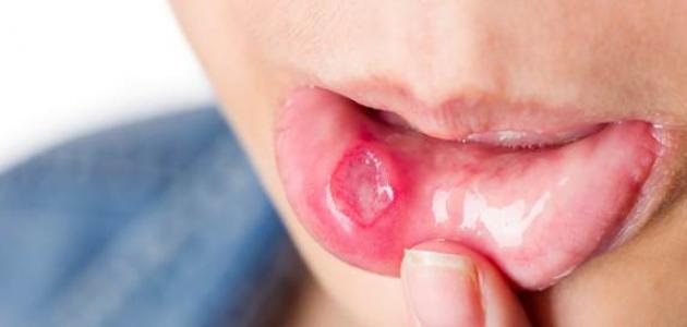 طريقة علاج تقرحات الفم