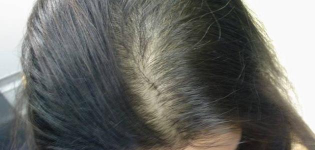 كيفية علاج تساقط الشعر طبيعياً