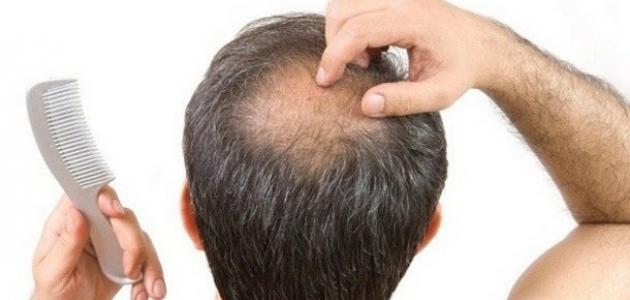 فوائد بول الإبل لتساقط الشعر