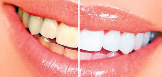 ما هو سبب اصفرار الأسنان