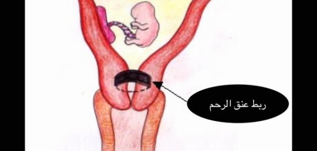 ما هو ربط الرحم