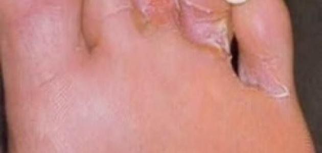 علاج فطريات ما بين أصابع القدم