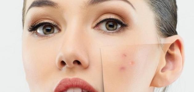 علاج آثار البثور في الوجه