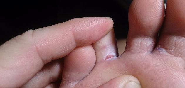 الفطريات بين أصابع القدم