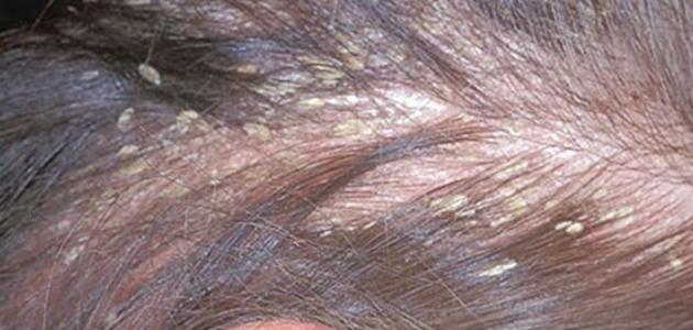 طريقة لإزالة القشرة من الشعر