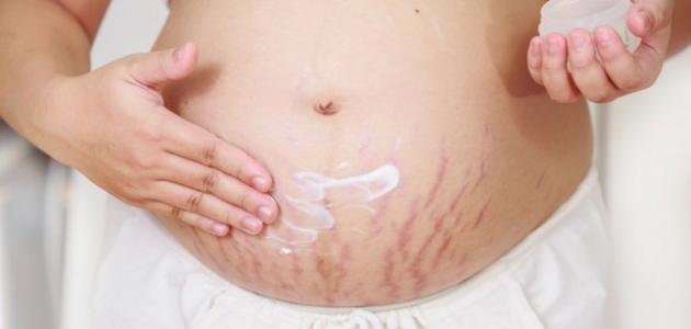 كيف تتجنب الحامل تشققات البطن