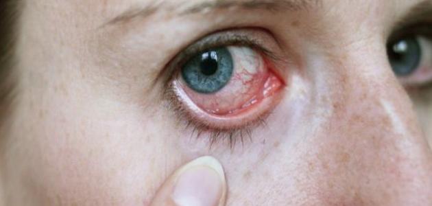 أعراض مرض شبكية العين