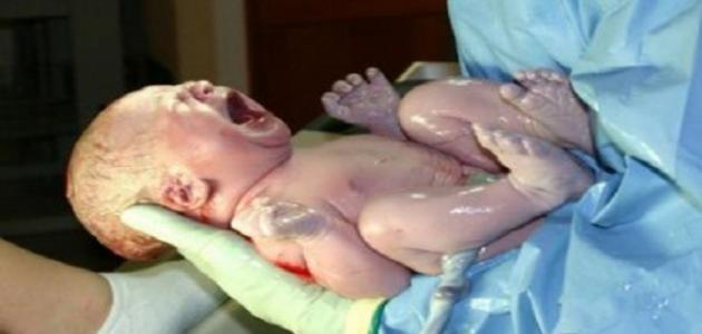 ما هى مخاطر الولادة القيصرية