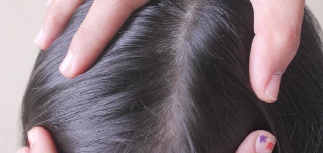 كيف أعرف بوجود القمل في الشعر