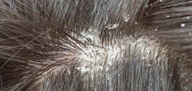 علاج الفطريات في الشعر بالأعشاب