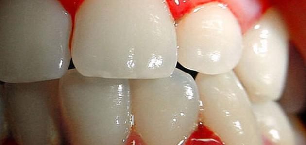 ما هو علاج التهاب لثة الأسنان