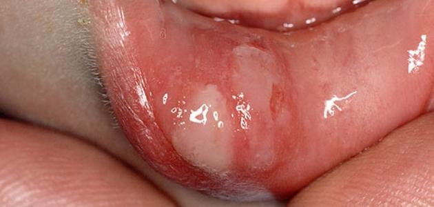 كيف أعالج فطريات الفم