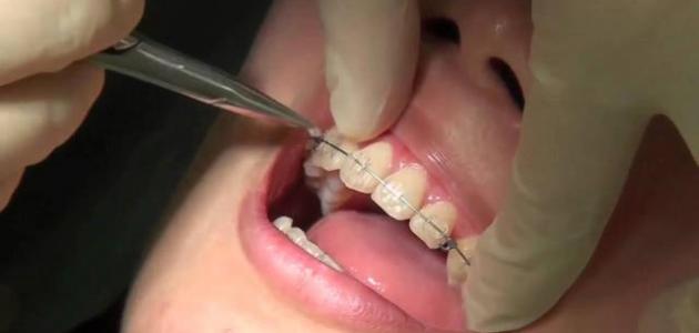 طريقة إزالة تقويم الأسنان