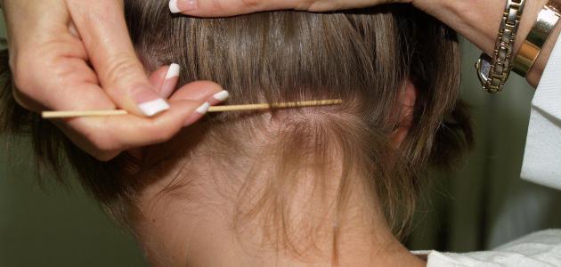 علاج قمل الشعر بالأعشاب