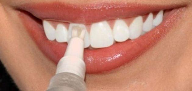 كيف يتم تبييض الاسنان