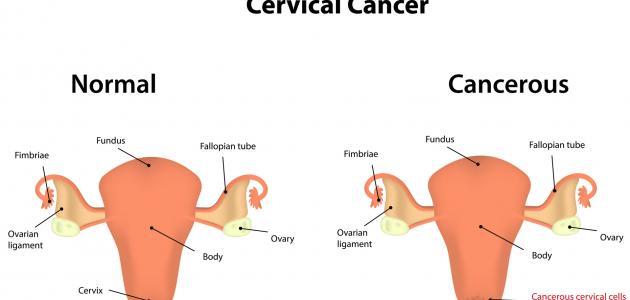ما أعراض سرطان الرحم