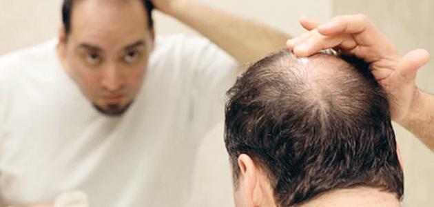 كيف توقف تساقط الشعر عند الرجال