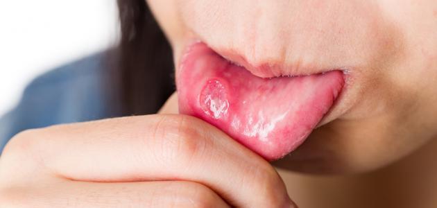 مرض فطريات الفم