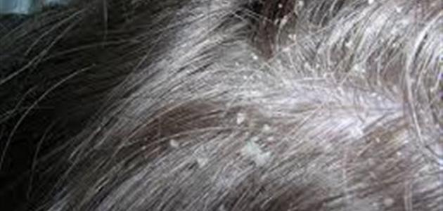 أسباب القشرة في الشعر وعلاجها