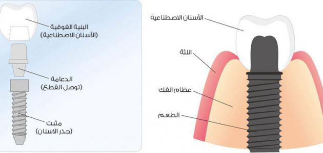 مراحل زراعة الأسنان