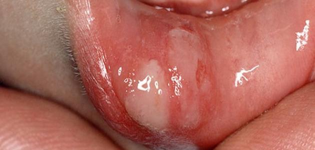 علاج فطريات الفم