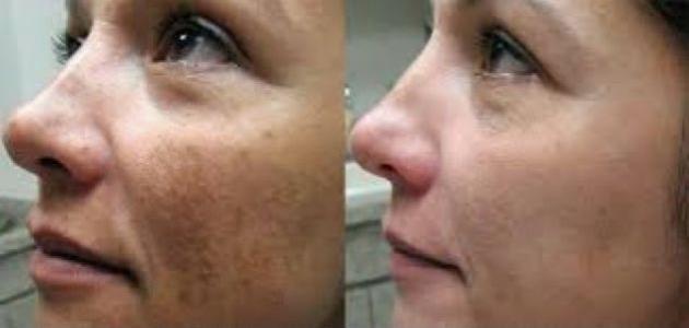 طرق لإزالة آثار الحروق من الوجه