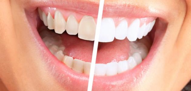 هل إزالة الجير من الأسنان مؤلم حروف عربي