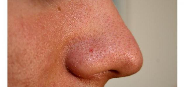 كيفية علاج مسامات الوجه