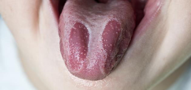 أسباب الفطريات في الفم عند الأطفال