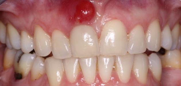 الاسنان اعراض خراج خراج الأسنان: