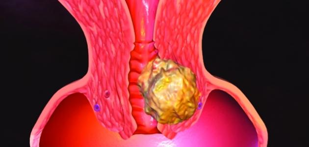 ما هي أمراض عنق الرحم