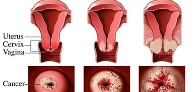 ما هي أعراض سرطان عنق الرحم