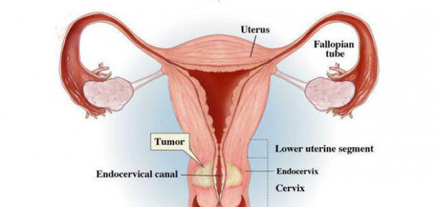 أعراض سرطان عنق الرحم المبكرة