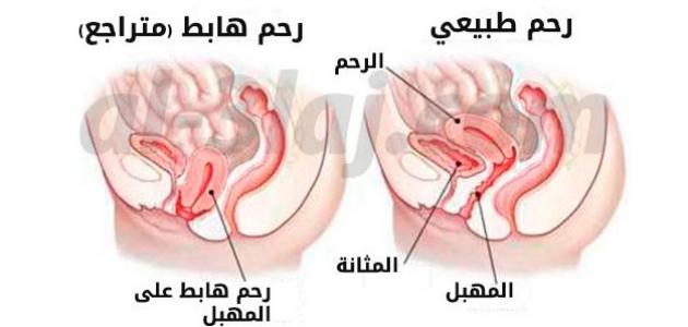 ما هي أعراض نزول الرحم