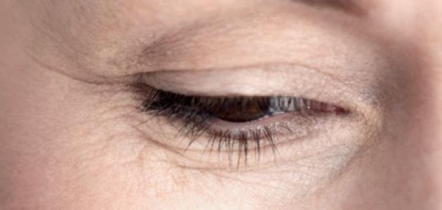 كيفية علاج تجاعيد حول العين