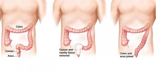 ما هي عوارض سرطان القولون
