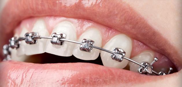 ما هي اضرار تقويم الاسنان حروف عربي