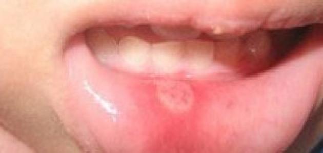 سبب ظهور الحبوب داخل الفم