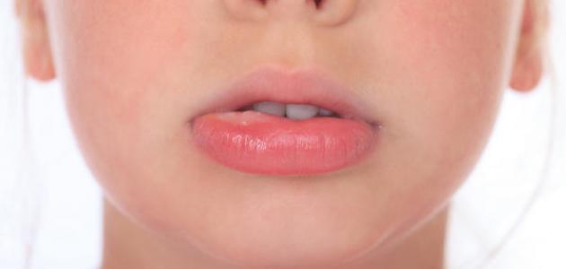 علاج طبيعي لتقرحات الفم