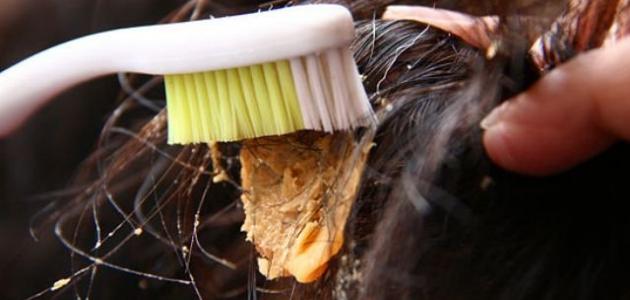 كيفية إزالة العلكة من الشعر