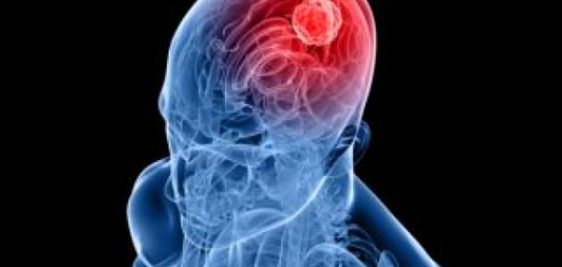 ما هي أعراض نزيف الدماغ