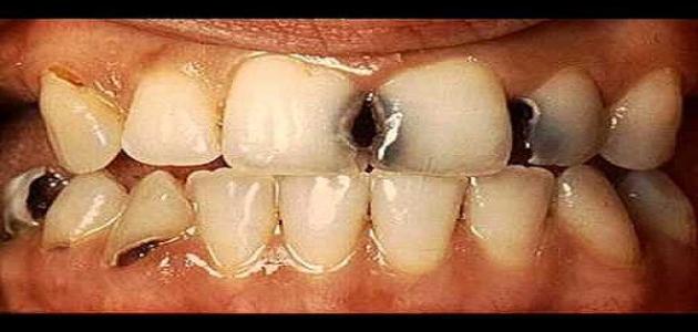 كيف نعالج تسوس الأسنان